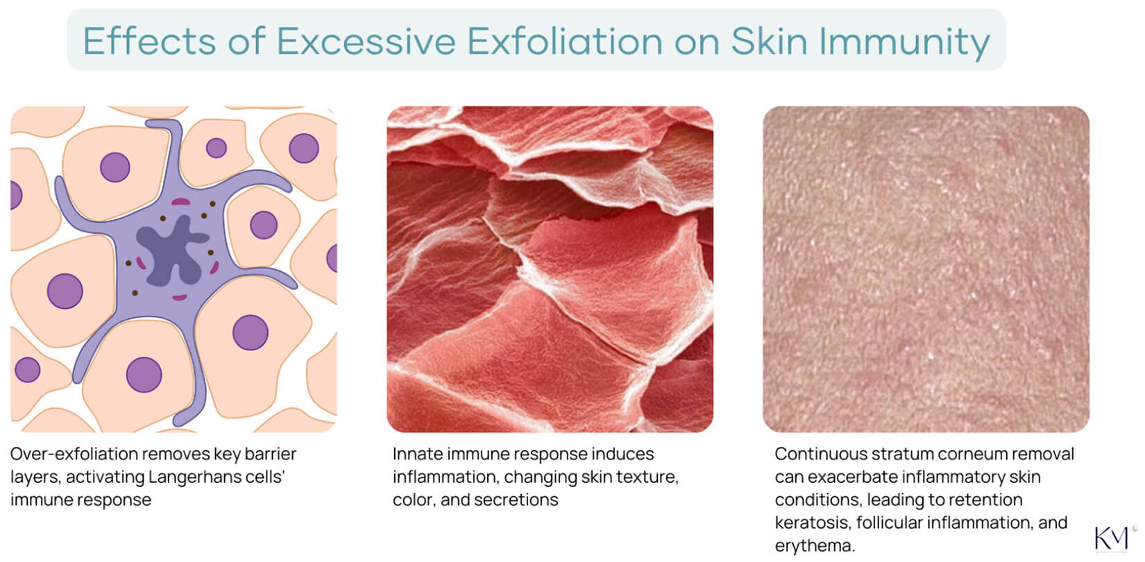 Effects of Excessive Exfoliation on Skin Immunity